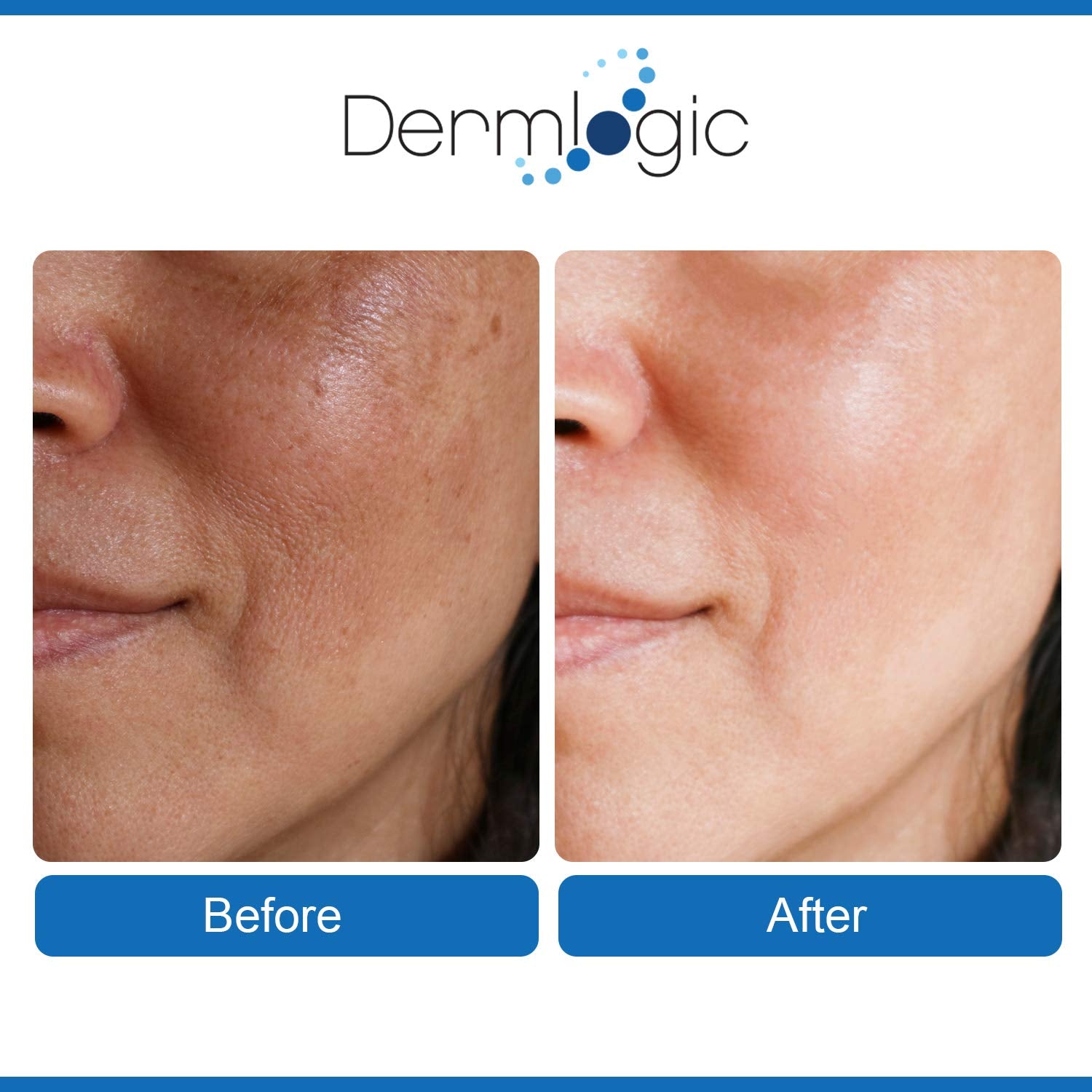 Dermlogic Anti Aging Resurfacing Peel Pads-Triple Action Chemical Peel Pads Combined With Glycolic, Lactic, And Salicylic Acids. Smooth'S Fine Lines, Wrinkles, Dark Spots, And Imperfections